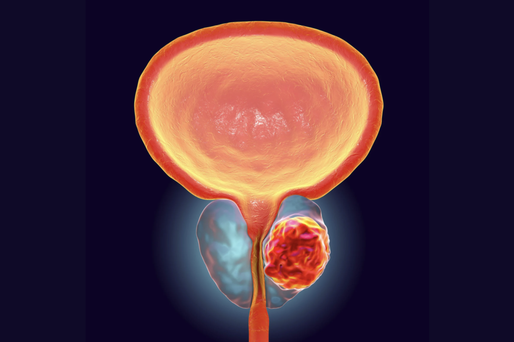 prostata aumentada